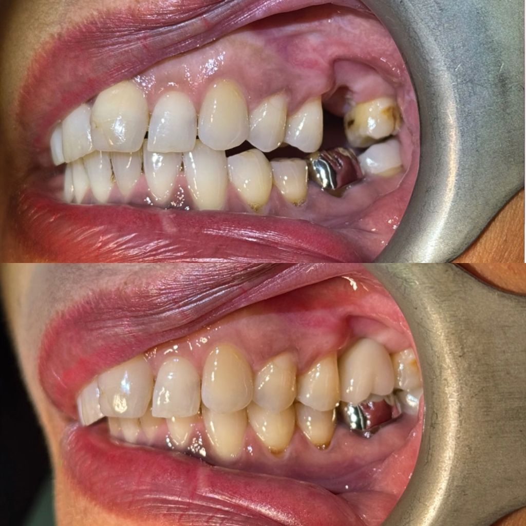 Before After Implant cases 2