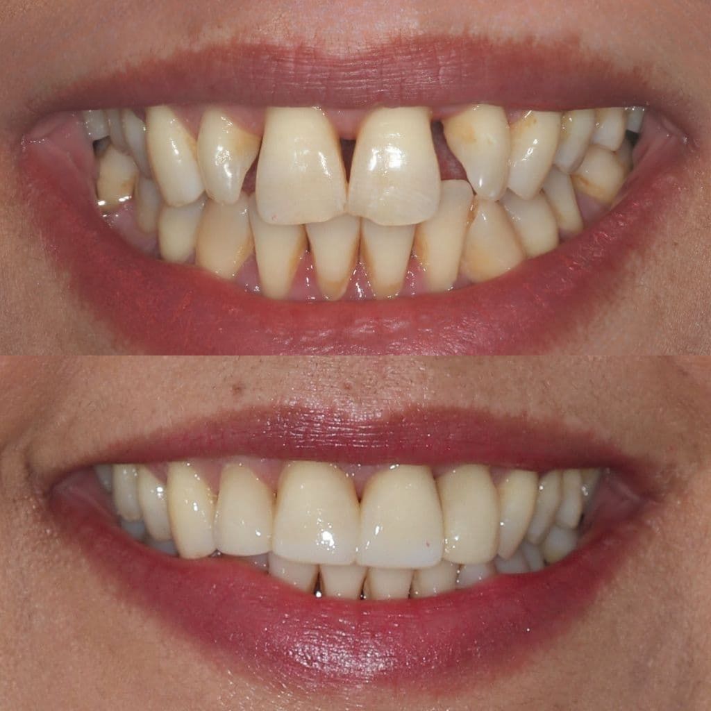 Before After Invisalign cases 1