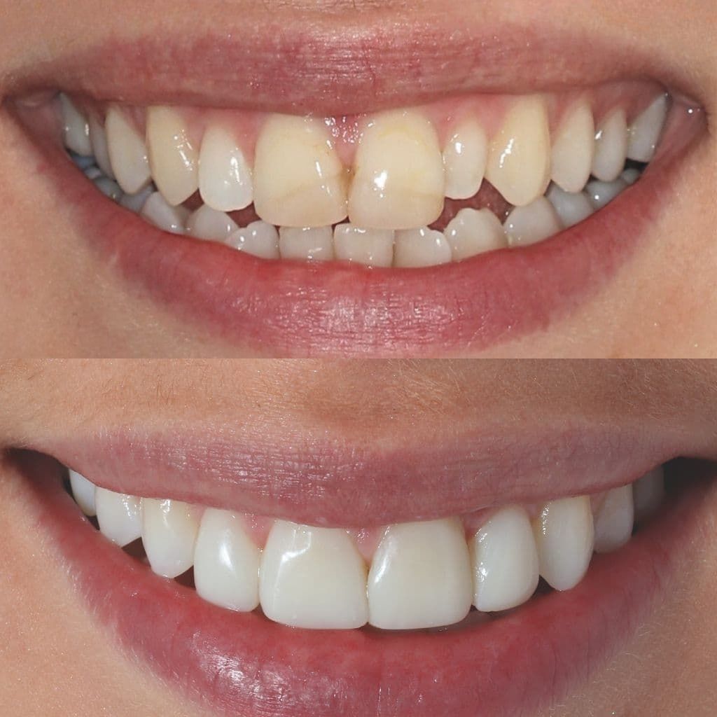 Before After Invisalign cases 2