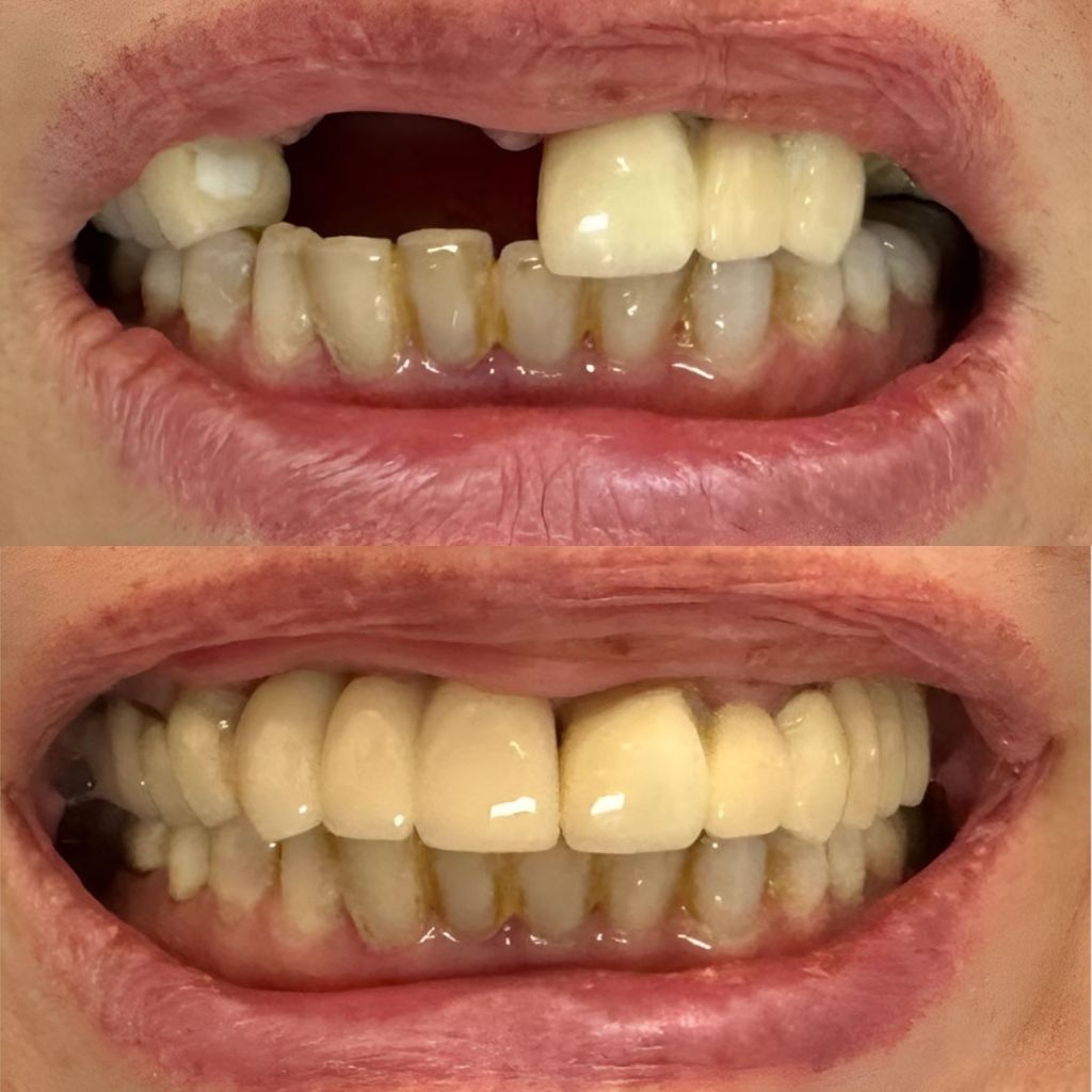 Before After implant cases 1